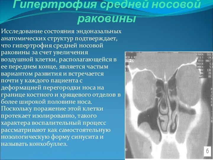 Гипертрофия средней носовой раковины Исследование состояния эндоназальных анатомических структур подтверждает,