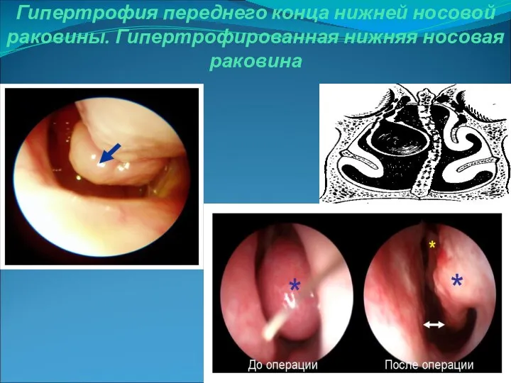 Гипертрофия переднего конца нижней носовой раковины. Гипертрофированная нижняя носовая раковина