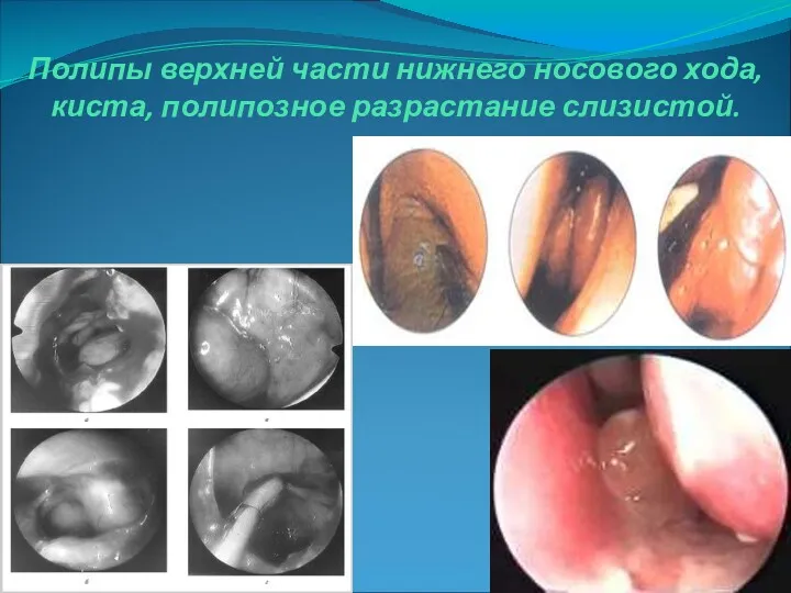 Полипы верхней части нижнего носового хода, киста, полипозное разрастание слизистой.