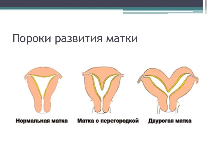 Пороки развития матки