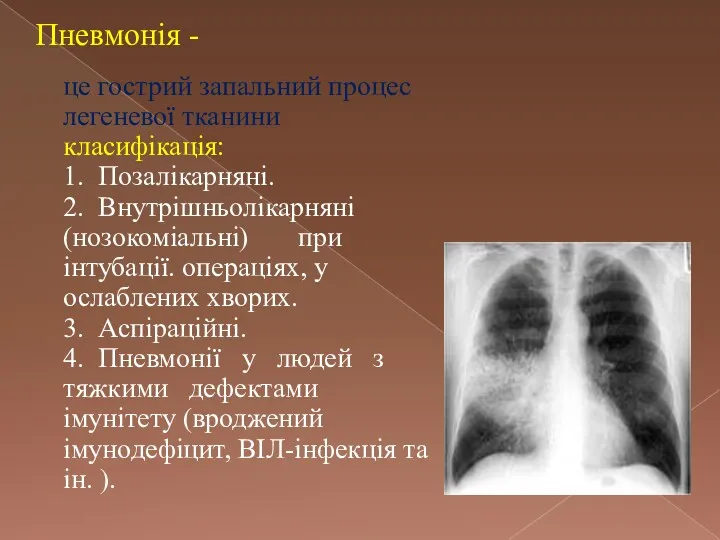 Пневмонія - це гострий запальний процес легеневої тканини класифікація: 1.