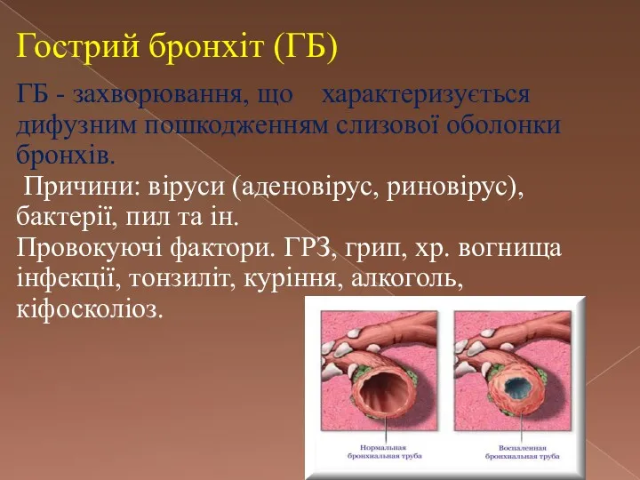 Гострий бронхіт (ГБ) ГБ - захворювання, що характеризується дифузним пошкодженням
