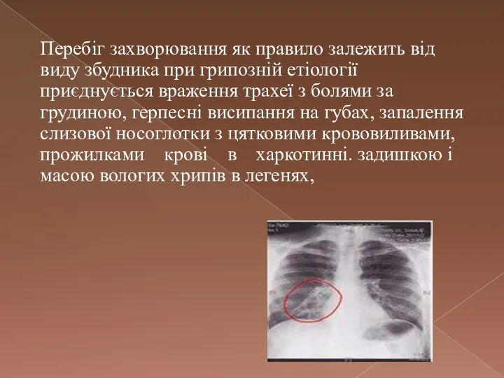 Перебіг захворювання як правило залежить від виду збудника при грипозній етіології приєднується враження