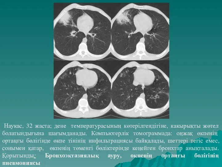 Наукас, 32 жаста; дене температурасының көтерілгендігіне, какырықты жөтел болатындығына шағымданады. Компьютерлік томограммада: оңжақ