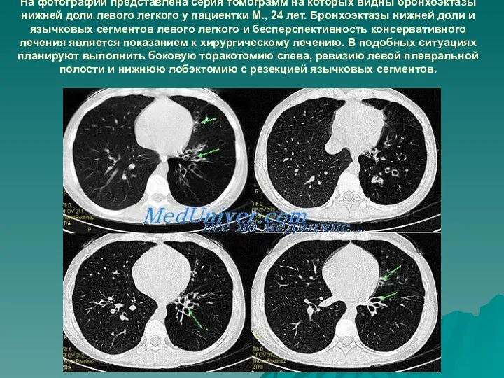 На фотографии представлена серия томограмм на которых видны бронхоэктазы нижней