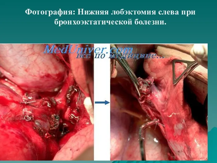 Фотография: Нижняя лобэктомия слева при бронхоэктатической болезни.