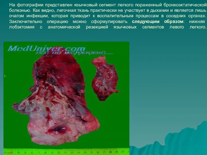На фотографии представлен язычковый сегмент легкого пораженный бронхоэктатической болезнью. Как