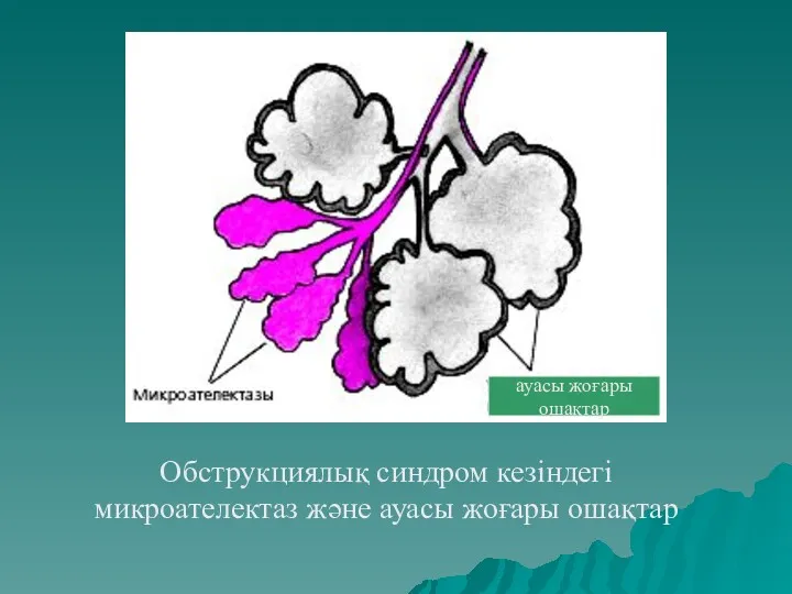 Обструкциялық синдром кезіндегі микроателектаз және ауасы жоғары ошақтар ауасы жоғары ошақтар