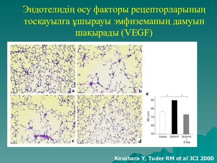 Эндотелидің өсу факторы рецепторларының тосқауылға ұшырауы эмфиземаның дамуын шақырады (VEGF) Kasahara Y, Tuder