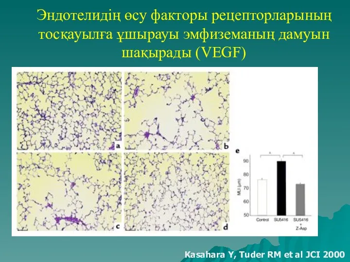 Эндотелидің өсу факторы рецепторларының тосқауылға ұшырауы эмфиземаның дамуын шақырады (VEGF)