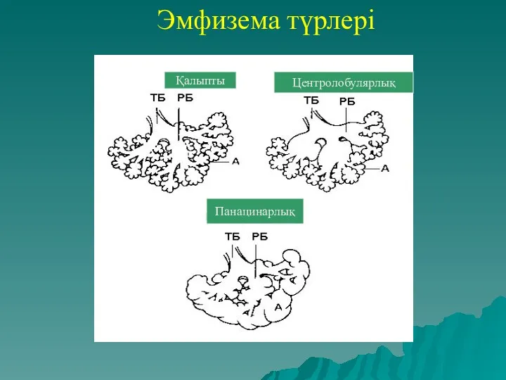 Эмфизема түрлері Қалыпты Центролобулярлық Панацинарлық