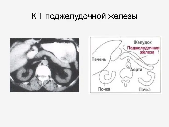 К Т поджелудочной железы