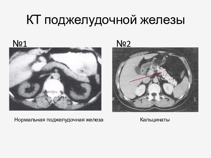 КТ поджелудочной железы №1 №2 Нормальная поджелудочная железа Кальцинаты