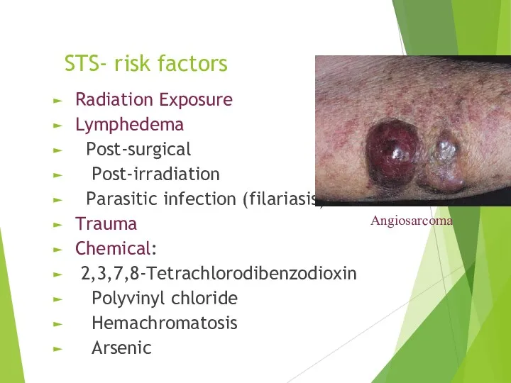 STS- risk factors Radiation Exposure Lymphedema Post-surgical Post-irradiation Parasitic infection