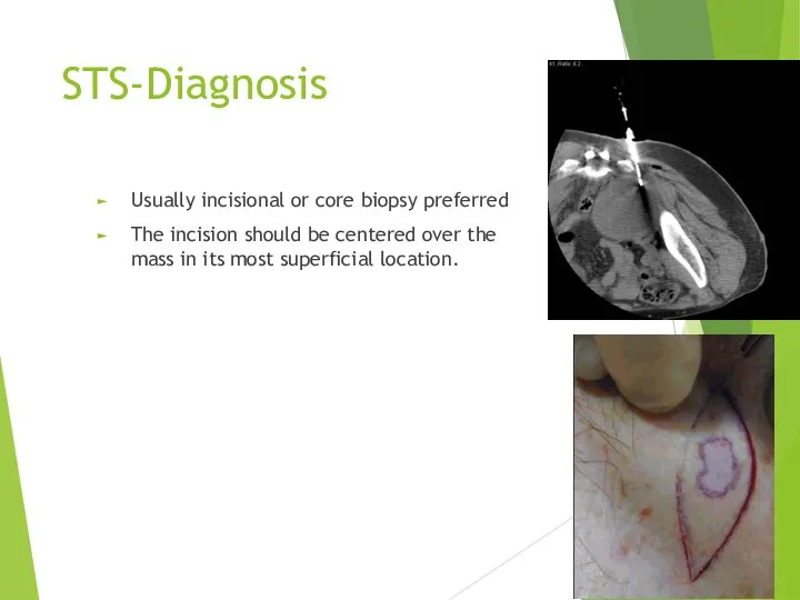 STS-Diagnosis Usually incisional or core biopsy preferred The incision should