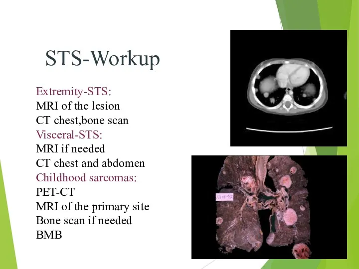 STS-Workup Extremity-STS: MRI of the lesion CT chest,bone scan Visceral-STS: