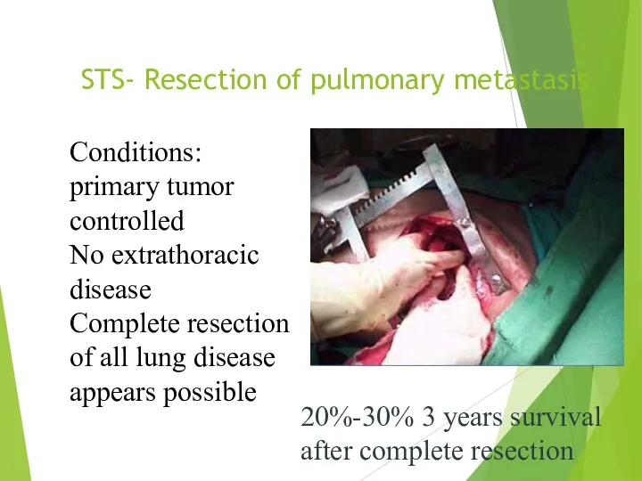 STS- Resection of pulmonary metastasis Conditions: primary tumor controlled No