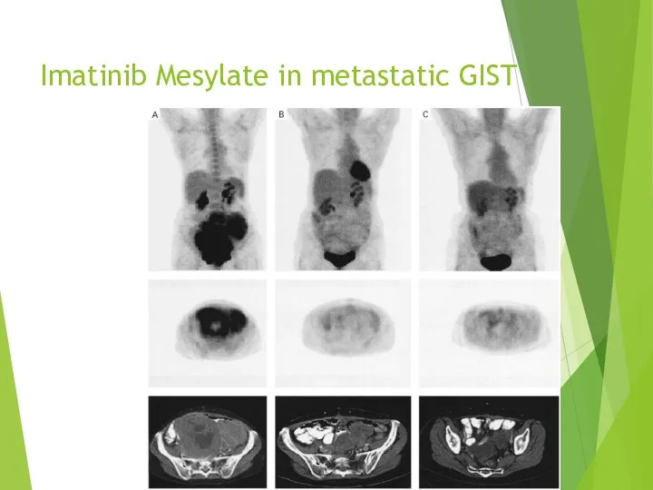 Imatinib Mesylate in metastatic GIST