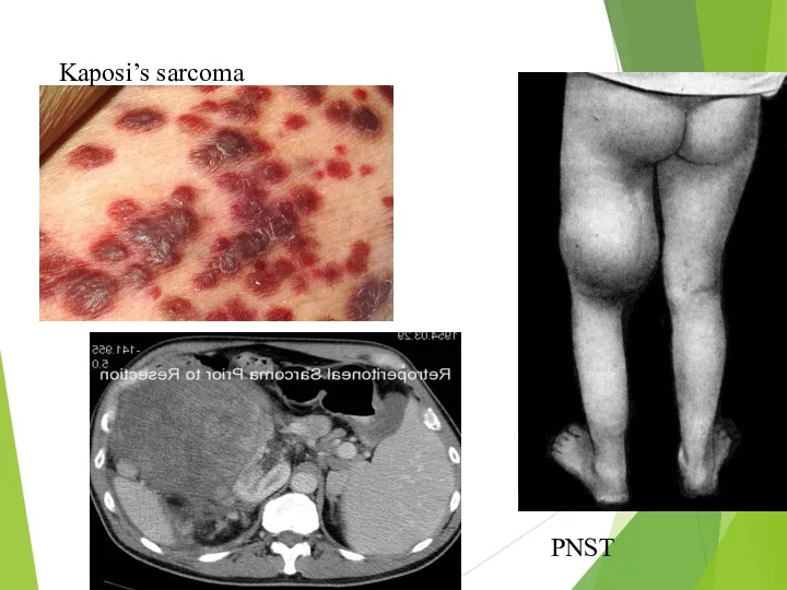 Kaposi’s sarcoma PNST