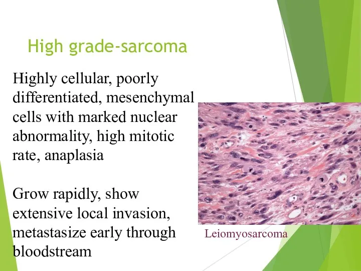 High grade-sarcoma Highly cellular, poorly differentiated, mesenchymal cells with marked