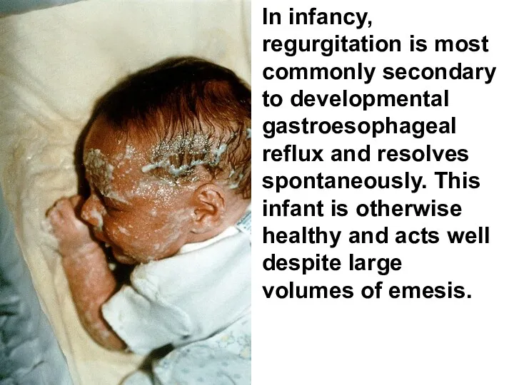 In infancy, regurgitation is most commonly secondary to developmental gastroesophageal