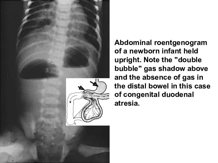 Abdominal roentgenogram of a newborn infant held upright. Note the