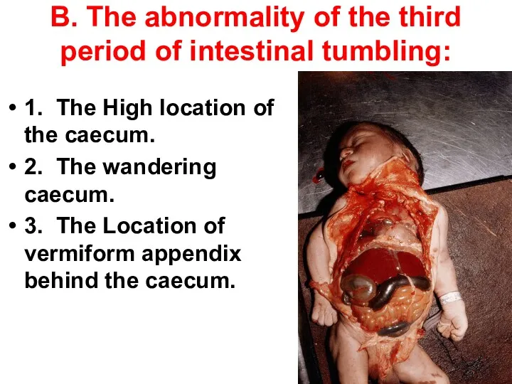 В. The abnormality of the third period of intestinal tumbling:
