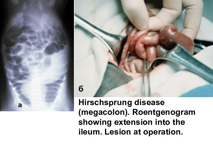 Hirschsprung disease (megacolon). Roentgenogram showing extension into the ileum. Lesion at operation. а б