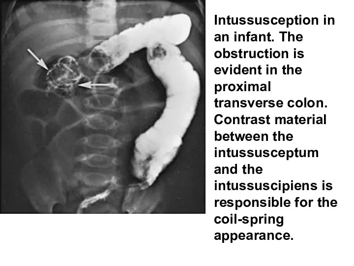 Intussusception in an infant. The obstruction is evident in the