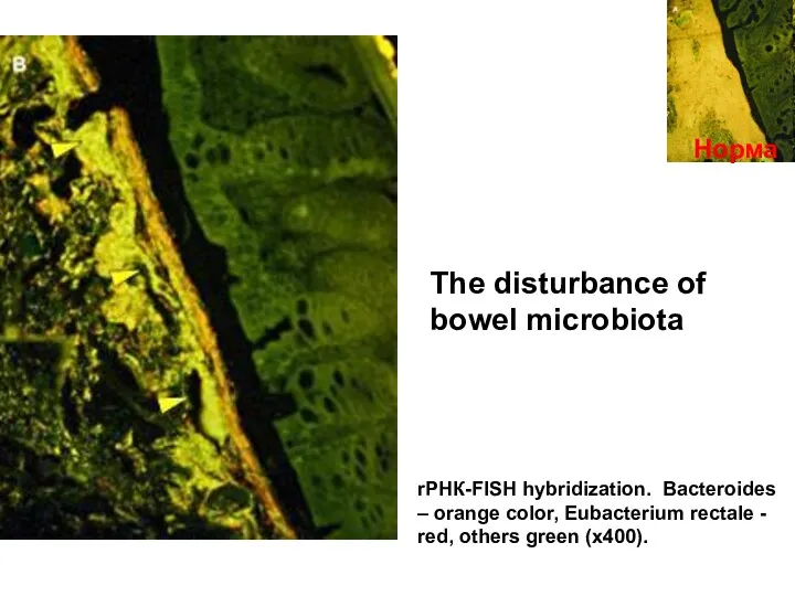 Норма The disturbance of bowel microbiota rРНК-FISH hybridization. Bacteroides –