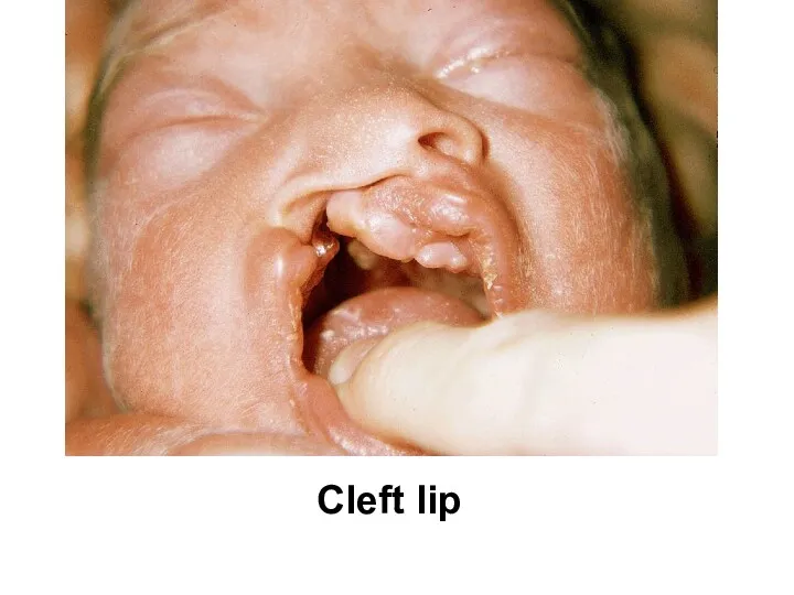 Cleft lip