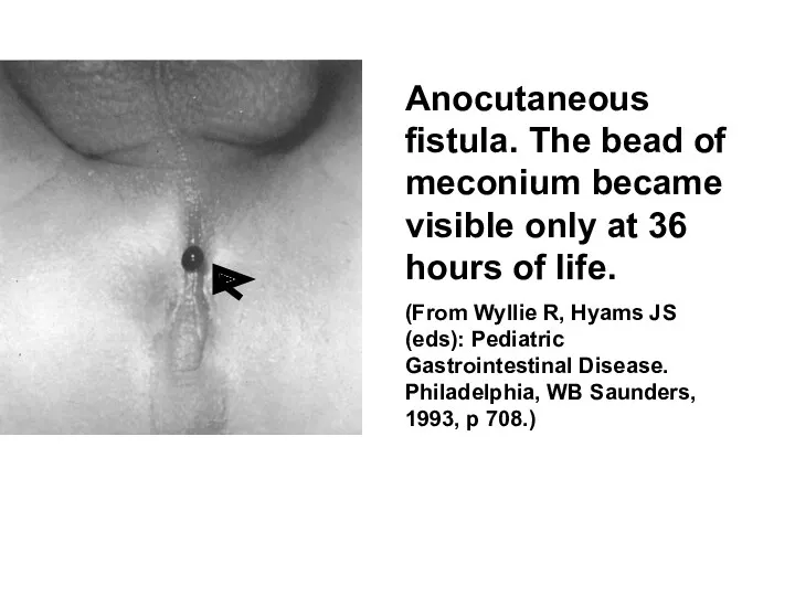 Anocutaneous fistula. The bead of meconium became visible only at