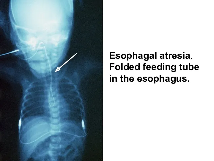 Esophagal atresia. Folded feeding tube in the esophagus.