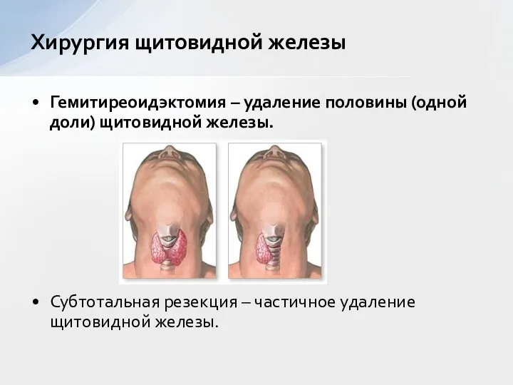 Гемитиреоидэктомия – удаление половины (одной доли) щитовидной железы. Субтотальная резекция