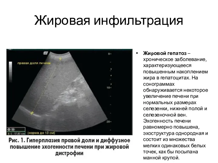 Жировая инфильтрация Жиpовой гепатоз – хроническое заболевание, характеризующееся повышенным накоплением