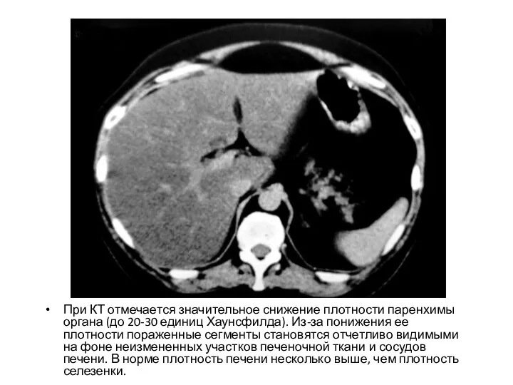 При КТ отмечается значительное снижение плотности паренхимы органа (до 20-30