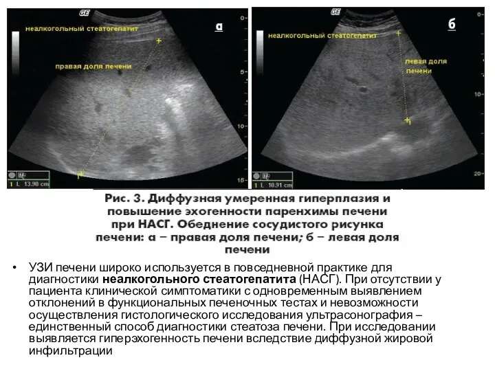 УЗИ печени широко используется в повседневной практике для диагностики неалкогольного
