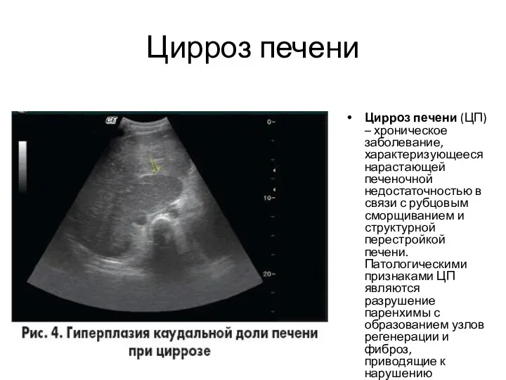 Цирроз печени Цирроз печени (ЦП) – хроническое заболевание, характеризующееся нарастающей