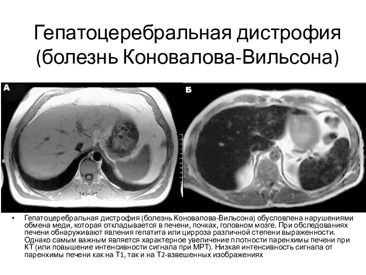 Гепатоцеребральная дистрофия (болезнь Коновалова-Вильсона) Гепатоцеребральная дистрофия (болезнь Коновалова-Вильсона) обусловлена нарушениями