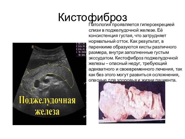 Кистофиброз Патология проявляется гиперсекрецией слизи в поджелудочной железе. Её консистенция
