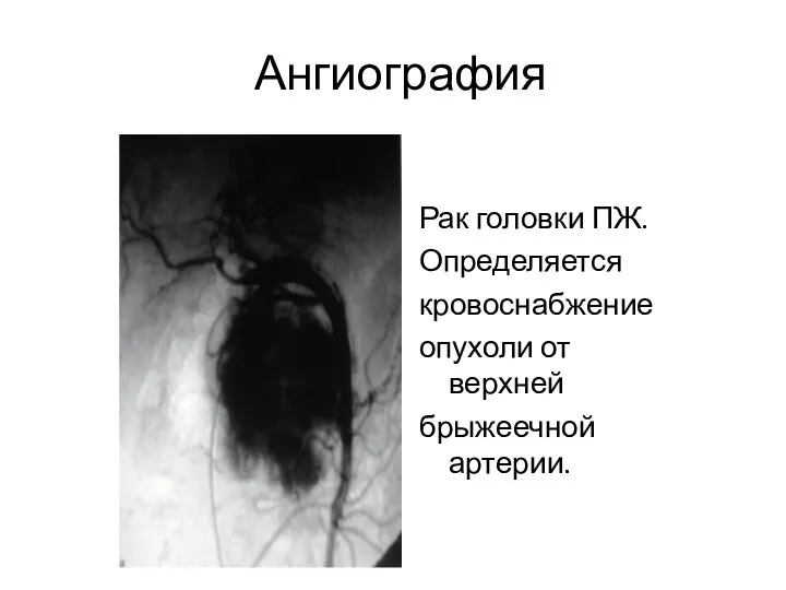 Ангиография Рак головки ПЖ. Определяется кровоснабжение опухоли от верхней брыжеечной артерии.