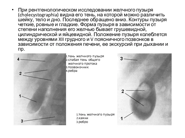 При рентгенологическом исследовании желчного пузыря (cholecystographia) видна его тень, на