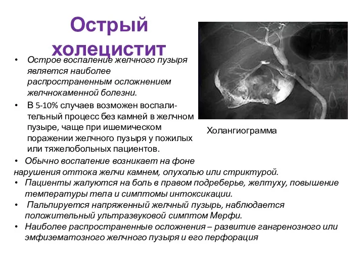 Острый холецистит Острое воспаление желчного пузыря является наиболее распространенным осложнением