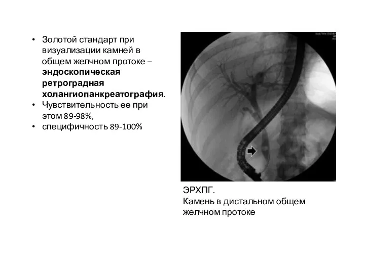 ЭРХПГ. Камень в дистальном общем желчном протоке Золотой стандарт при