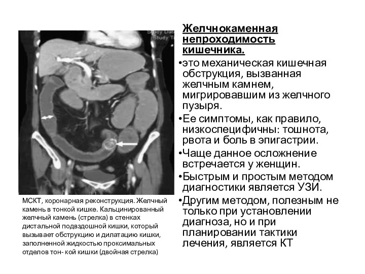 Желчнокаменная непроходимость кишечника. это механическая кишечная обструкция, вызванная желчным камнем,