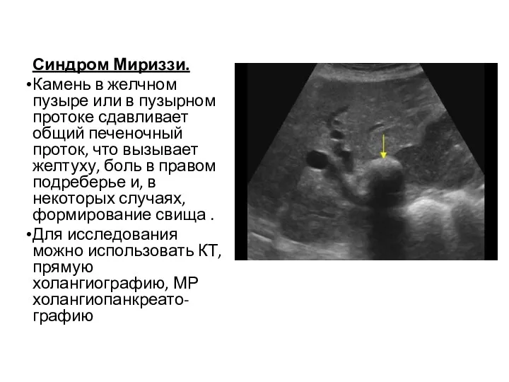 Синдром Мириззи. Камень в желчном пузыре или в пузырном протоке