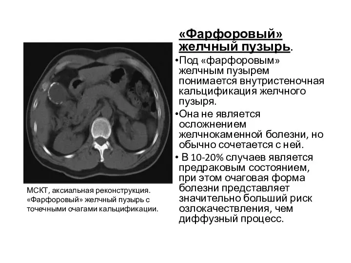 «Фарфоровый» желчный пузырь. Под «фарфоровым» желчным пузырем понимается внутристеночная кальцификация