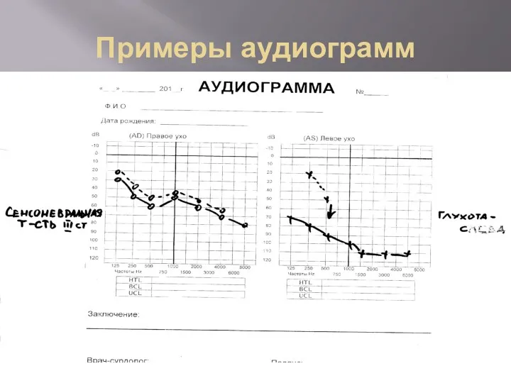 Примеры аудиограмм