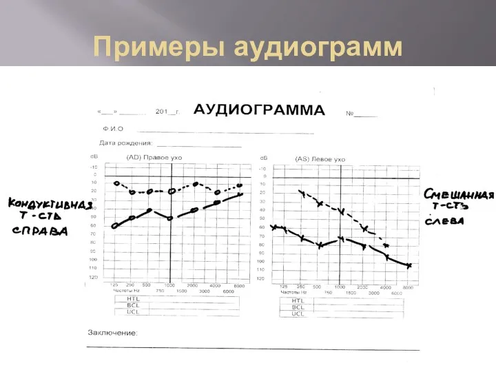 Примеры аудиограмм