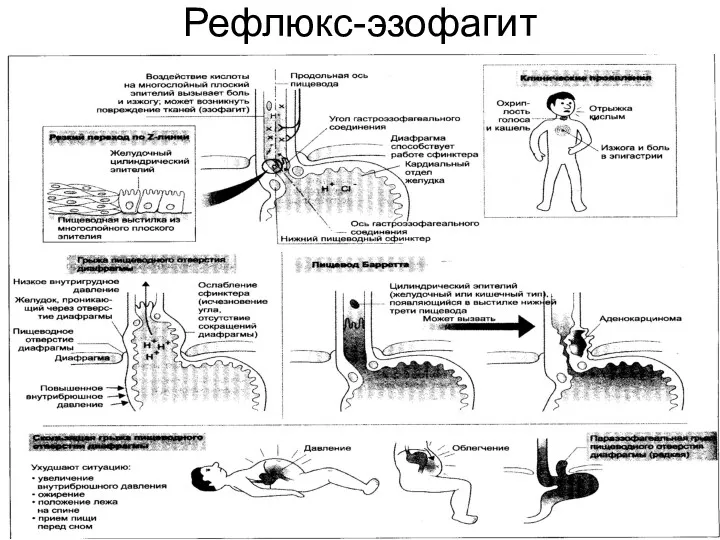 Рефлюкс-эзофагит